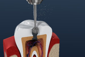 model of a root canal, with the tooth being drilled into reaching the infected pulp